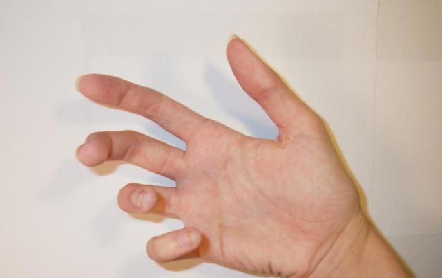 体内有癌,手指先知?注意:手指出现这些症状,要注意疾病信号 体内有癌,手指先知?注意:手指出现这些症状,要注意疾病信号