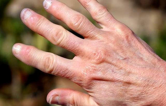 体内有癌,手指先知?注意:手指出现这些症状,要注意疾病信号 体内有癌,手指先知?注意:手指出现这些症状,要注意疾病信号