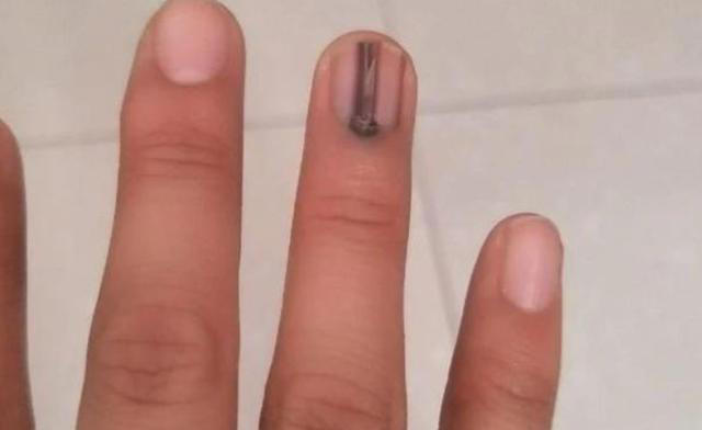 体内有癌,手指先知?注意:手指出现这些症状,要注意疾病信号 体内有癌,手指先知?注意:手指出现这些症状,要注意疾病信号