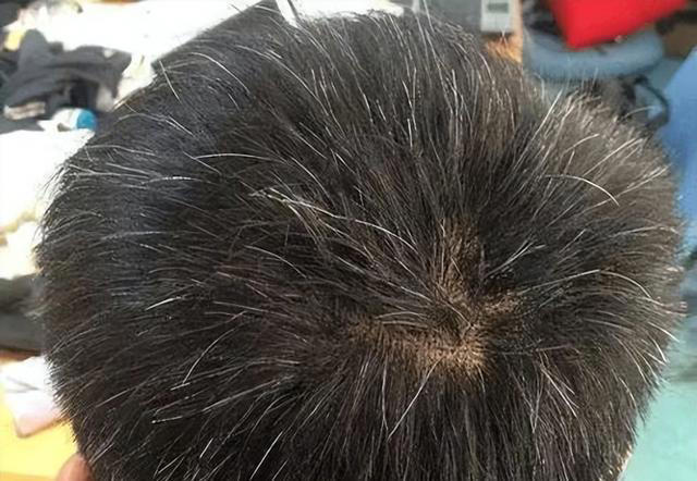 医生发现，凡是白发早生的人，大多都有2个共性，日常不妨多观察