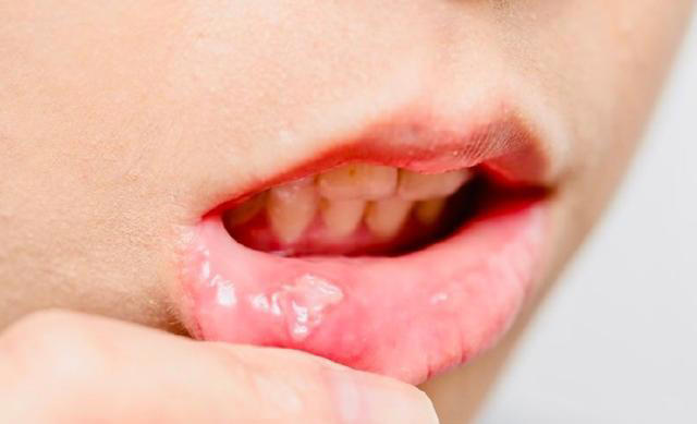 你以为的上火，可能是癌症信号，出现这4种症状，该做检查了